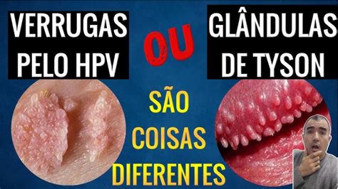 glandulas de tyson ou hpv|Glândulas De Tyson E Hpv